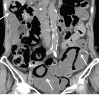 症例4 遠隔画像診断事業 症例紹介 特発性腸管嚢腫様気腫症 株式会社ワイズ リーディング